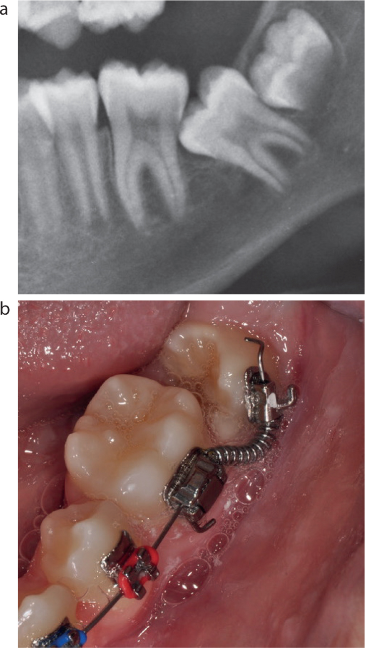 Second molar teeth hotsell