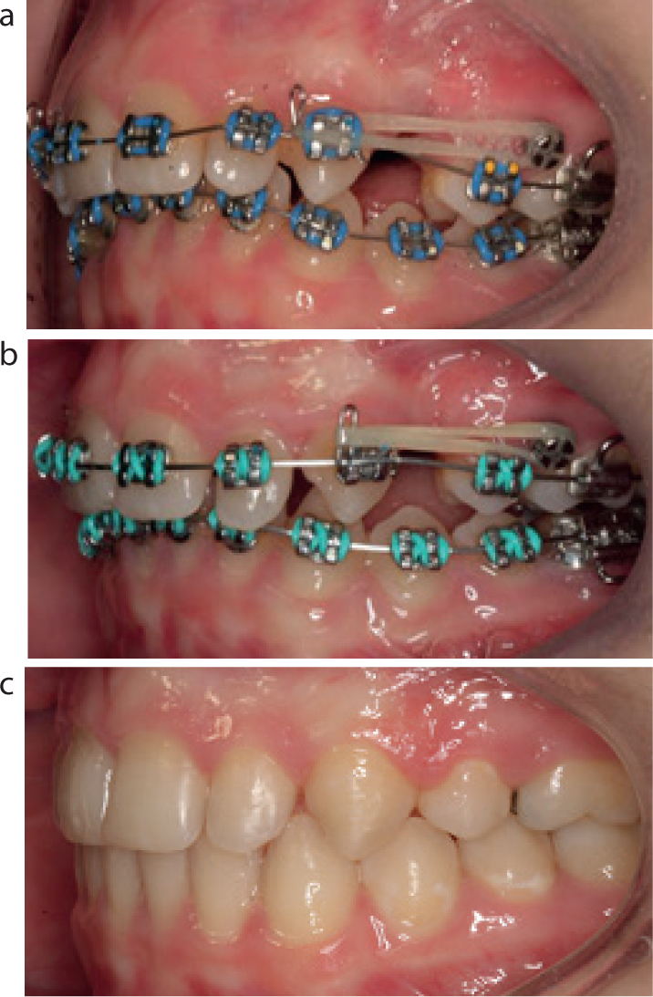 Elastics in orthodontics - Orthodontics in Summary