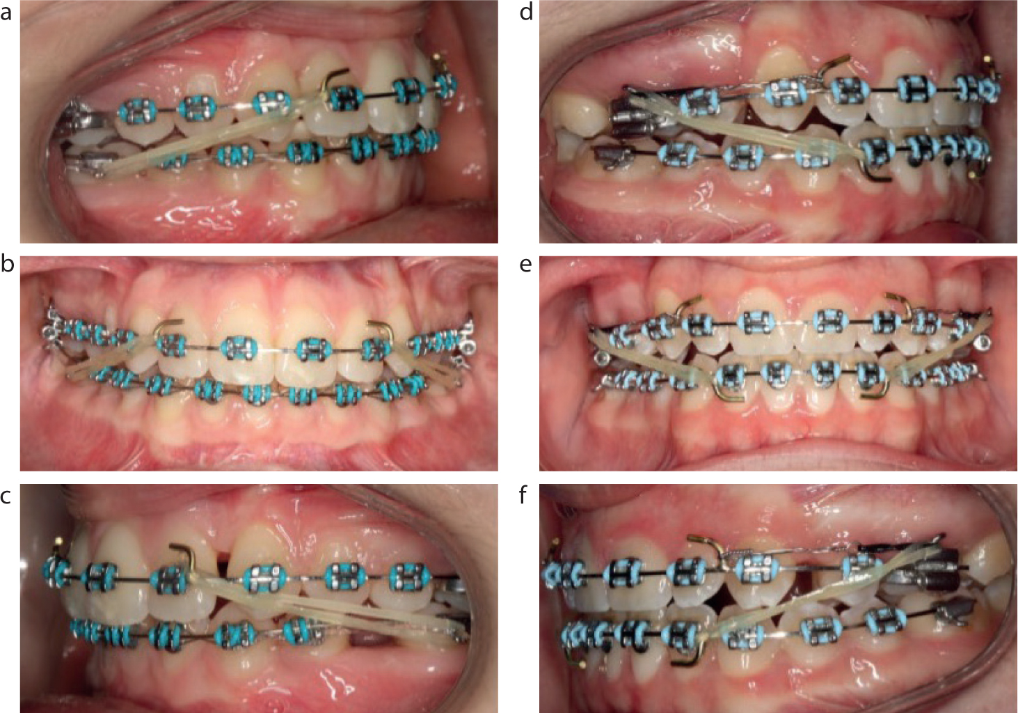 Interarch elastics are important to a successful orthodontic