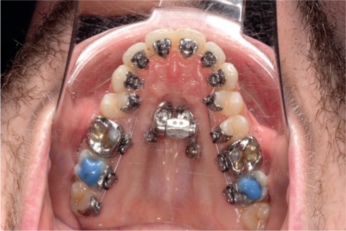 Orthodontic Update - Rapid maxillary expansion: a clinical insight for the  general dental practitioner