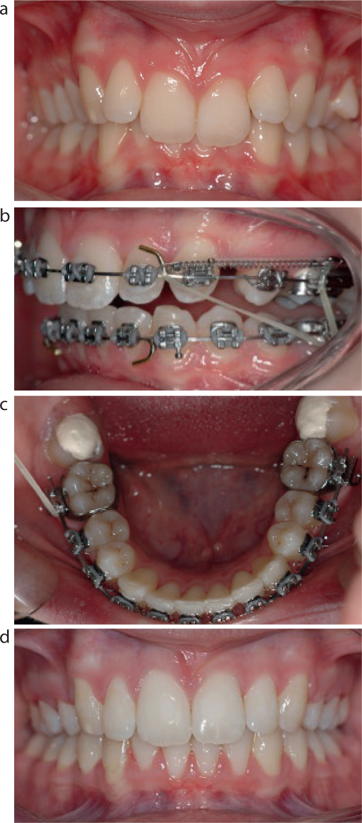 Orthodontic Treatment for Overjet (Overbite) - Rubber Bands 