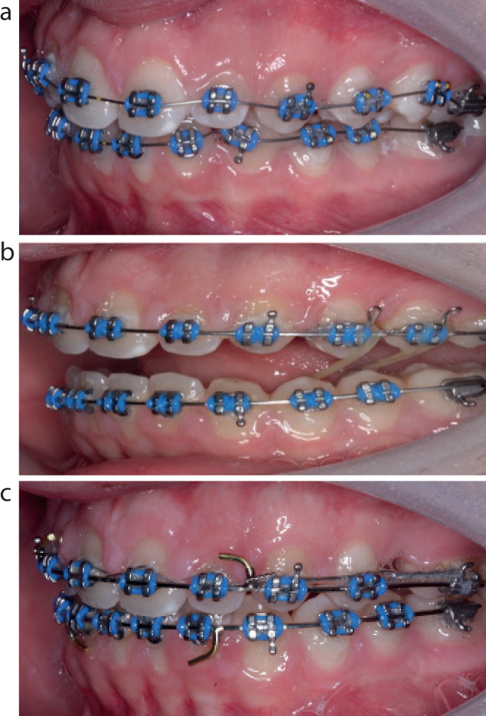 Cross shop elastics orthodontics