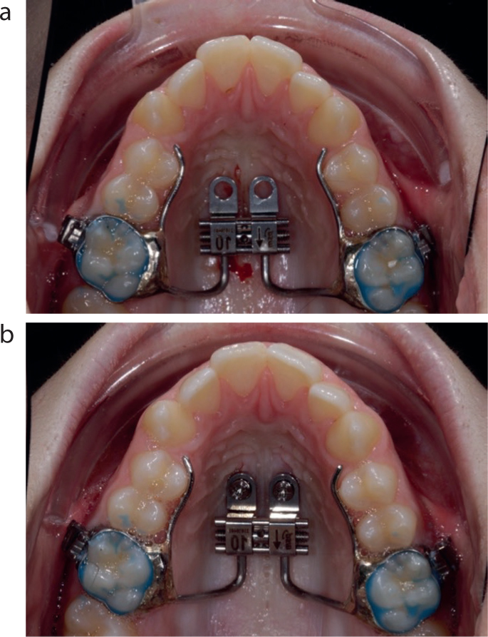 Palatal Expansion  ODL Orthodontic Labs